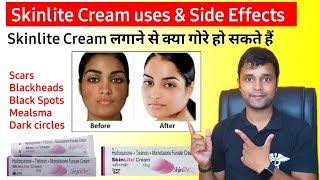 Honest Review Of Skinlite Cream In Hindi गरपन क करम Uses And Side Effects Of Skinlite Cream
