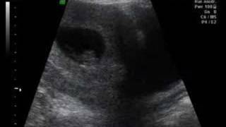 Anne karnında 8 haftalık gebelikte ultrasonografi