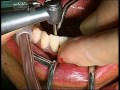 Astra Dental Implants Immediate Loading - six implants in lower jaw