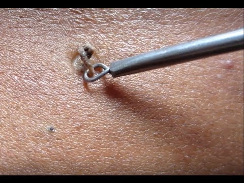 Cara Membuang Black Head