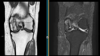 Osteonecrosis Of The Knee