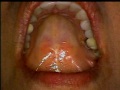 Physics Forceps #14 Endo Treated Tooth Extraction