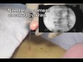 Lumbar Facet Joint Injection - PalmHarborOrtho.com