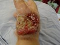 amputacion
