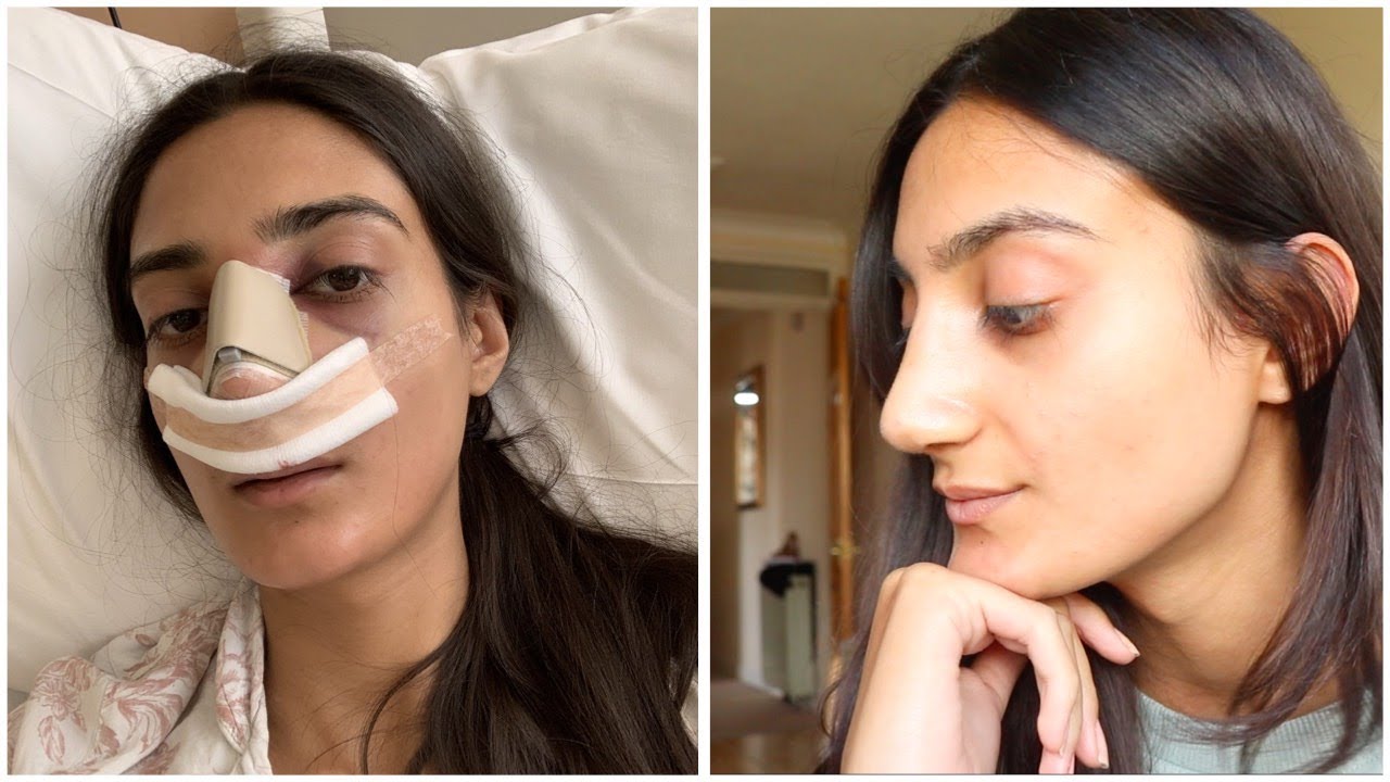 Reduce swelling brusing facial surgery