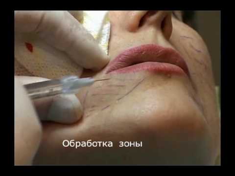 Коррекция дефицита объема периоральной области филлером Regenyal Idea. Техника вертикальных вколов. Коррекция дефицита объема периоральной области филлером Regenyal Idea. Техника вертикальных вколов.