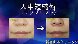 人中短縮術(鼻下短縮・リップリフト) 山本クリニック
