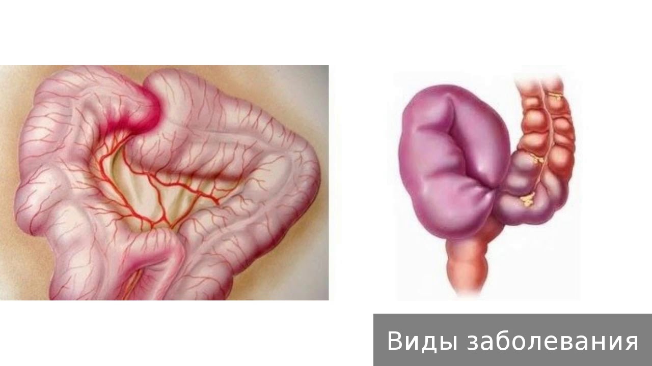 Диета После Непроходимости Кишечника Без Операции