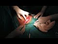 Caesarean Section Surgery (LUCS) in 3 Minutes  || ৩ মিনিটে সিজার ডেলিভারি