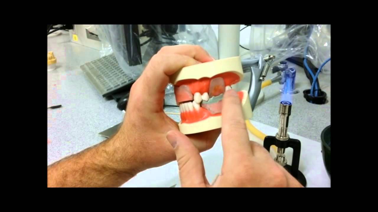 Bite registration using grey stick compound to mount mandibular RPD