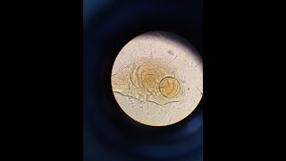 Corpora Amylacea وجودها دليل على سرطان بروستاتا