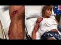Kangaroo attack: Jogger gets 35 stitches from vicious mauling by 2m-tall crazy kangaroo - TomoNews