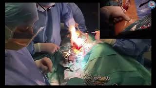 Concomitant use of Impella while on peripheral VA-ECMO: de-escalate and ambulate