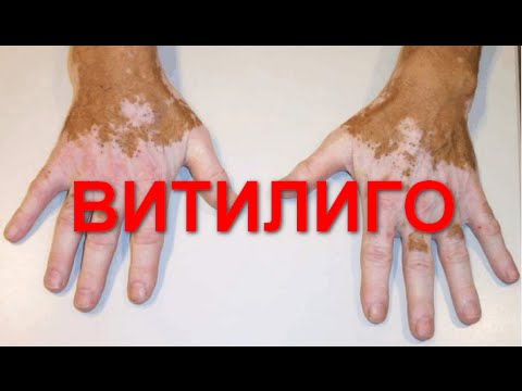 Как вылечить витилиго навсегда в домашних условиях 407