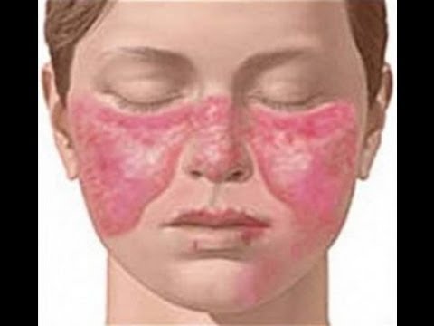lupis disease essay lupis disease essay