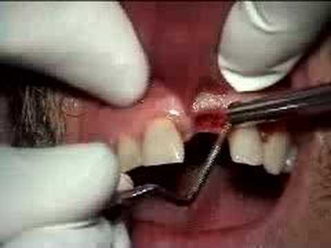 Dental Implant failure