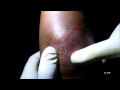 Abscess Draining At Cubital Fossa