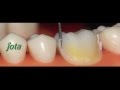 Preparación Dientes Posteriores - JOTA TRAINING - Jota Rotary Instruments