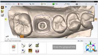 Planmeca PlanCAD Easy - Implant Workflow