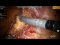 surgery
