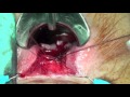 COLGAJO DE AVANCE RECTAL CON PLASTIA DE ESFINTER ANAL INTERNO