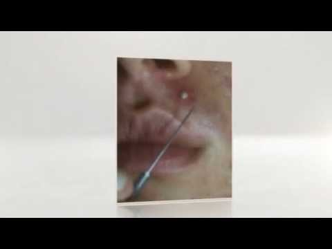 puistjes uitknijpen youtube