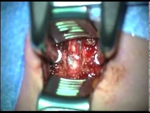 hernia symptomen