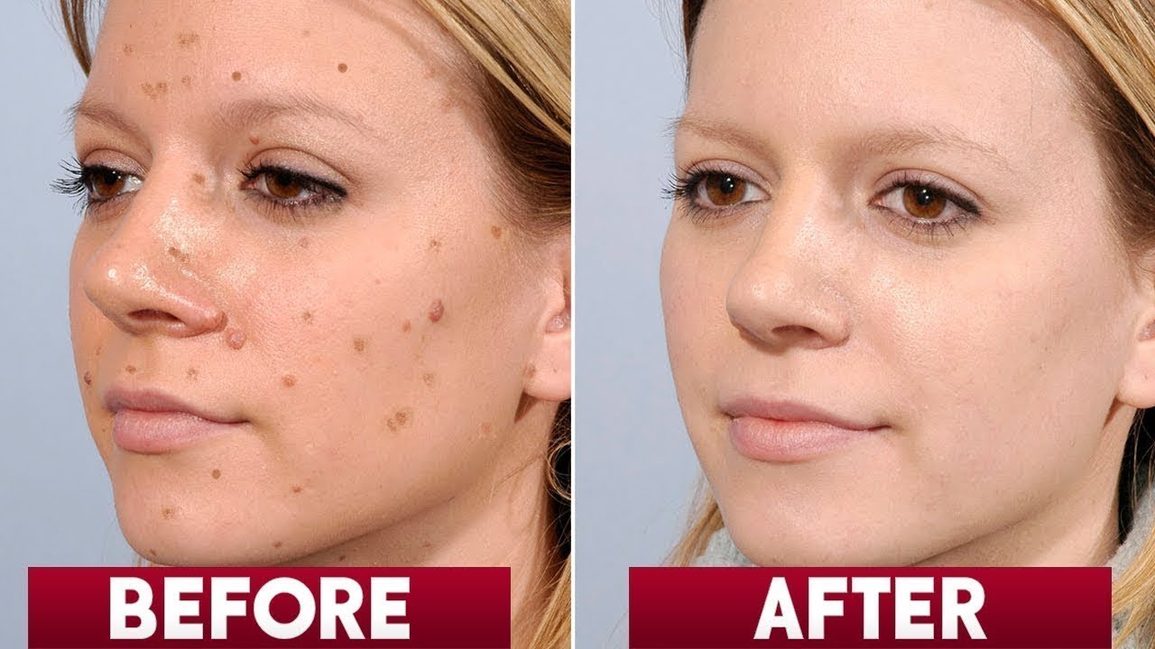 Diminish facial spots permanently