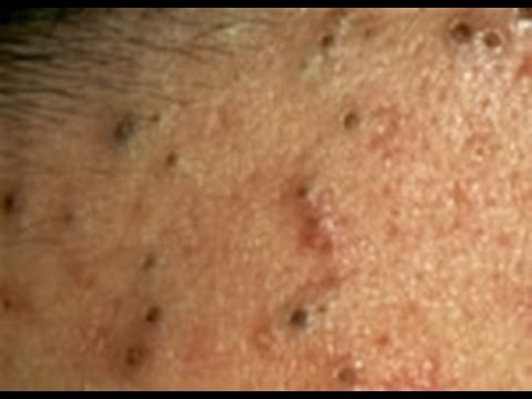Прыщи внутри которых кровь Прыщи внутри которых кровь