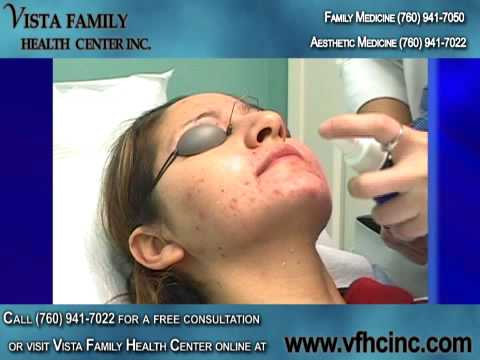 family health centers of san diego. Acne Treatment San Diego