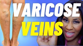 What Causes Varicose Veins? How Can You Treat Varicose Veins? A Doctor Explains