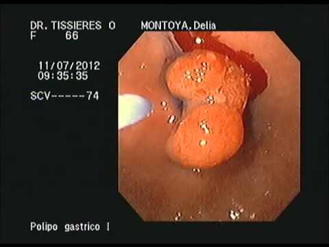 Polipo gástrico - Polipectomia endoscopica - YouTube