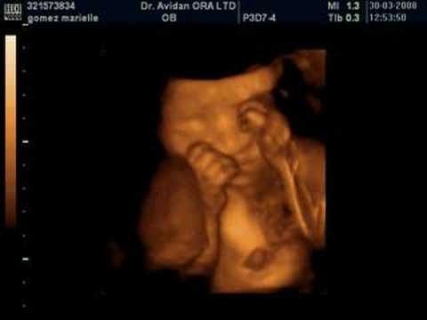 3d ultrasound pictures at 26 weeks. Our daughter in 3D UltraSound