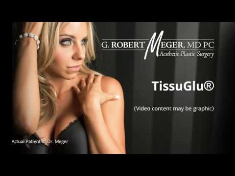 TissuGlu Application in Tummy Tuck Surgery | Plastic Surgery in Phoenix and Scottsdale AZ