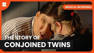 Living As A Conjoined Twin - Medical Incredible - Doentary