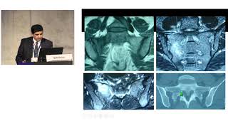 Treatment Of Sacral Insuffciency Fractures Debate By Prof Dr Sait Naderi