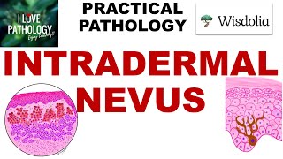 Intradermal Nevus Pathogenesis Clinical Features Morphology Prognosis