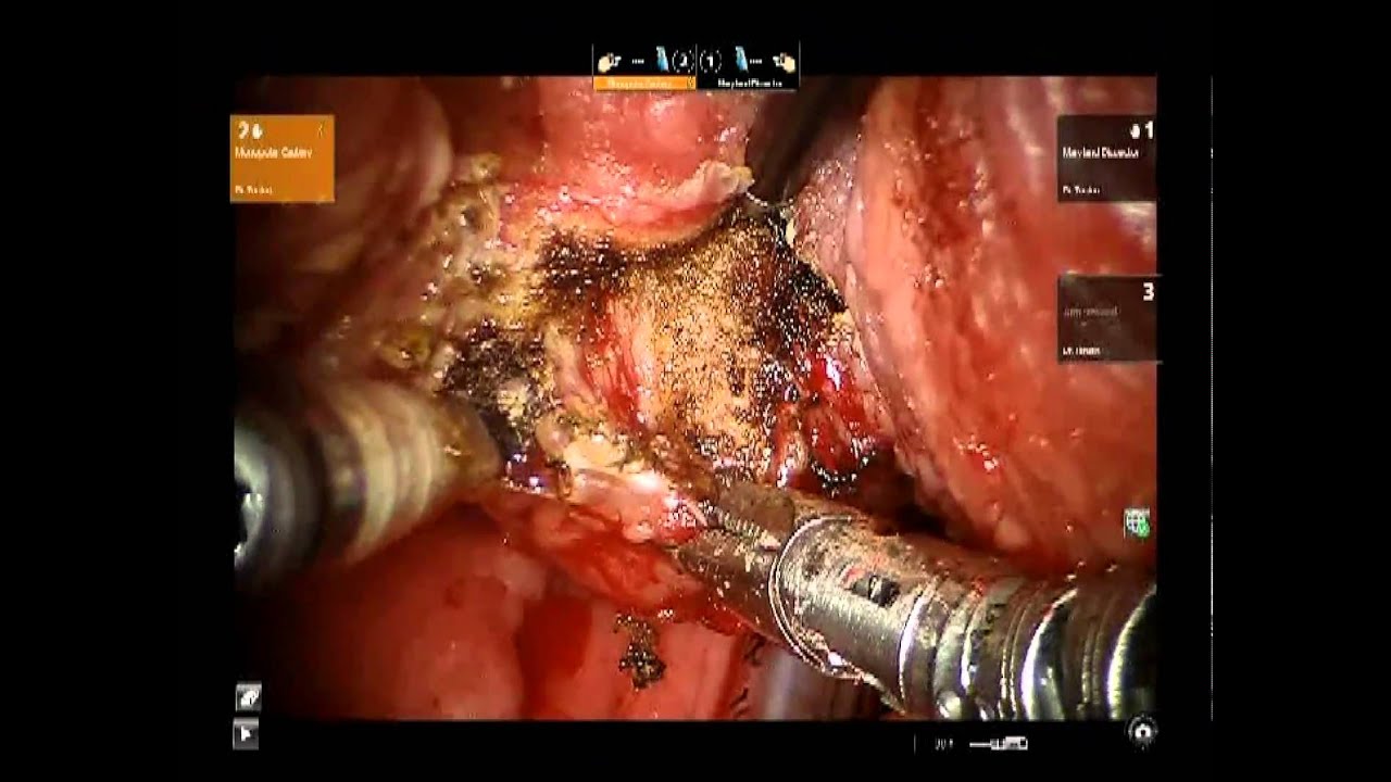 Transoral Robotic Surgery: Base of Tongue Resection - Johns Hopkins