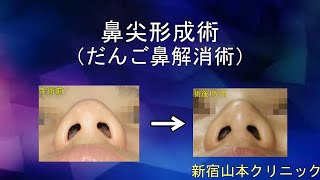 鼻尖形成(団子鼻修正・鼻尖軟骨縛り) 山本クリニック