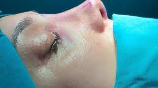 Preservation rhinoplasty/ Uzman Dr Tale Neimetzade