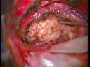 BRAIN TUMOR - TUMOR CEREBRAL