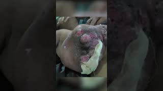 Mrm Modified Radical Mastectomy Breast Cancer Surgery By Dr Majid Ahmed Talikoti