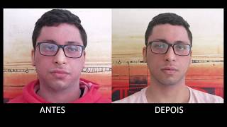 Matheus - Dermatite Atópica
