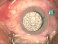 Vitrectomy for Vitreous Opacities (Floaters)