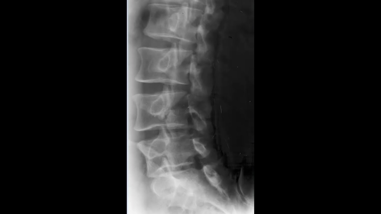 Lumbar Spine Oblique Radiology Tutorial - YouTube