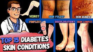 TOP 15 Diabetes Skin Signs & Symptoms [Type 2 & 1 Diabetes Mellitus]