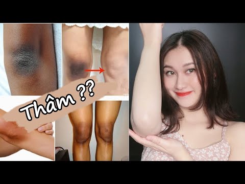 Trị thâm, làm trắng vùng đầu gối khuỷu tay mắt cá chân | Tự tin diện váy xinh ♡ | CHLOE DO