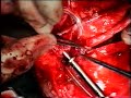 Redo Heart Surgery, 3 topends being anastomossed to the Aorta using Vettath Anastomotic Obturator