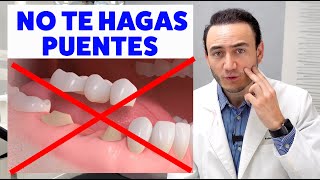 No Te Hagas Puentes Dentales Fijos, Sin Evaluar Primero Opciones Más Conservadoras.