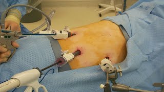 Adrenal Gland Removal Adrenalectomy Patient Information From Sages